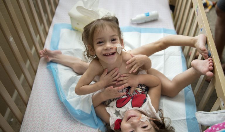 Conjoined twins get aid for separation surgery Conjoined twins get aid for separation surgery
